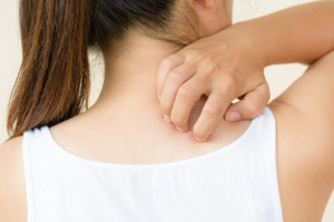 bed bug bites