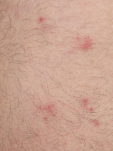 flea bites on skin